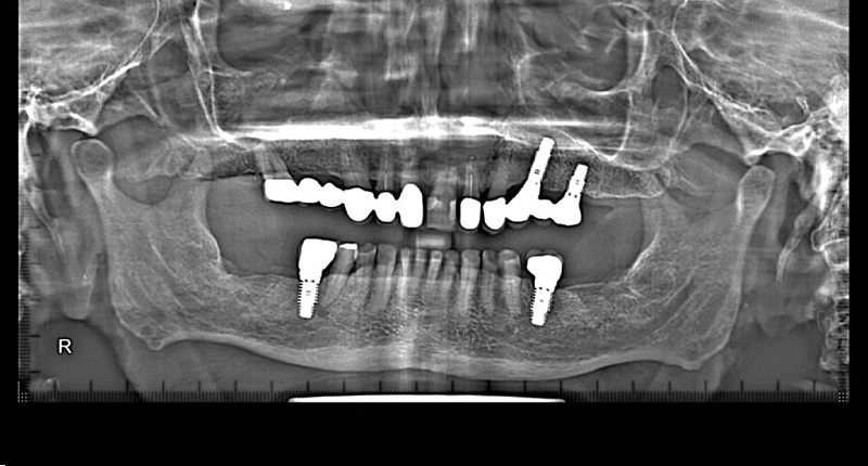 Dental Implants in Pune